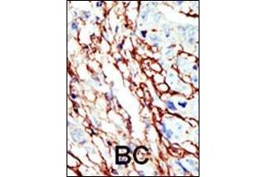 Formalin-fixed and paraffin-embedded human cancer tissue reacted with the primary antibody, which was peroxidase-conjugated to the secondary antibody, followed by AEC staining. (EPH Receptor A7 抗体  (C-Term))