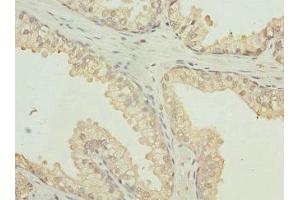 Immunohistochemistry of paraffin-embedded human prostate cancer using ABIN7167501 at dilution of 1:100 (PTPRB 抗体  (AA 1758-1997))