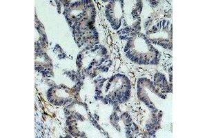 Immunohistochemical analysis of Survivin staining in human colon cancer formalin fixed paraffin embedded tissue section. (Survivin 抗体)
