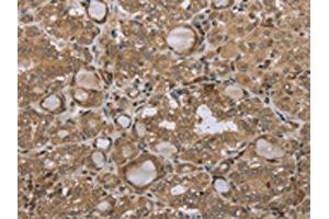 The image on the left is immunohistochemistry of paraffin-embedded Human thyroid cancer tissue using ABIN7192692(STMN2/STMN3/STMN4 Antibody) at dilution 1/45, on the right is treated with synthetic peptide. (STMN2/STMN3/STMN4 抗体)