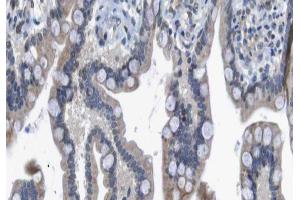 ABIN6266560 at 1/100 staining human colon carcinoma tissue sections by IHC-P. (HDAC7 抗体  (Internal Region))