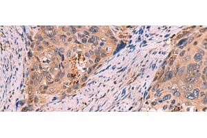Immunohistochemistry of paraffin-embedded Human cervical cancer tissue using SHC4 Polyclonal Antibody at dilution of 1:85(x200)