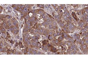 ABIN6277708 at 1/100 staining Human liver cancer tissue by IHC-P. (SLC3A2 抗体  (Internal Region))