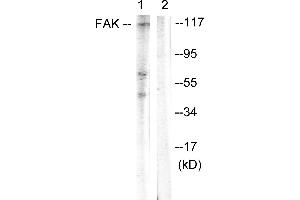 Immunohistochemistry analysis of paraffin-embedded human breast carcinoma tissue using FAK (Ab-397) antibody. (FAK 抗体  (Tyr397))