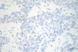 Immunohistochemistry was performed on paraffin-embedded human breast carcinoma using cyclin e2 antibody (ABIN7798199), 1:200). (Recombinant Cyclin E2 抗体)
