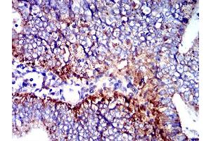 Immunohistochemical analysis of paraffin-embedded endometrial cancer tissues using CD107b mouse mAb with DAB staining. (LAMP2 抗体  (AA 29-168))
