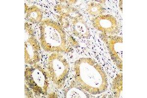 Immunohistochemical analysis of BCAR3 staining in human colon cancer formalin fixed paraffin embedded tissue section. (BCAR3 抗体  (C-Term))