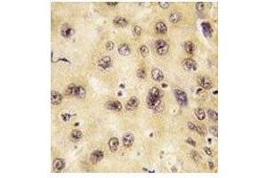 IHC analysis of FFPE human hepatocarcinoma tissue stained with PROX1 antibody (PROX1 抗体  (AA 185-214))