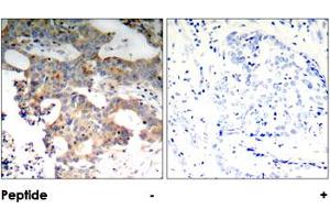 Immunohistochemical analysis of paraffin-embedded human breast carcinoma tissue using NFKBIE polyclonal antibody . (NFKBIE 抗体)