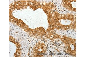 Immunohistochemistry of Human cervical cancer using TEKT1 Polyclonal Antibody at dilution of 1:30 (TEKT1 抗体)