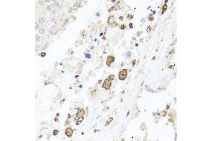 Immunohistochemistry of paraffin-embedded human lung cancer using BTK antibody at dilution of 1:100 (x40 lens). (BTK 抗体)