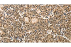 Immunohistochemistry of paraffin-embedded Human thyroid cancer tissue using MAP1A Polyclonal Antibody at dilution 1:40 (MAP1A 抗体)