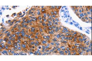 Immunohistochemistry of paraffin-embedded Human lung cancer using DRD4 Polyclonal Antibody at dilution of 1:30 (DRD4 抗体)