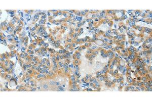 Immunohistochemistry of paraffin-embedded Human thyroid cancer using BAAT Polyclonal Antibody at dilution of 1:30