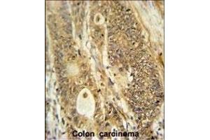 AVIL Antibody (N-term) (ABIN650952 and ABIN2840008) immunohistochemistry analysis in formalin fixed and paraffin embedded human colon carcinoma followed by peroxidase conjugation of the secondary antibody and DAB staining. (Advillin 抗体  (N-Term))