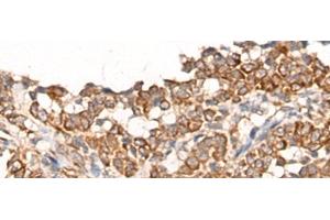 Immunohistochemistry of paraffin-embedded Human ovarian cancer tissue using CA5B Polyclonal Antibody at dilution of 1:65(x200) (CA5B 抗体)