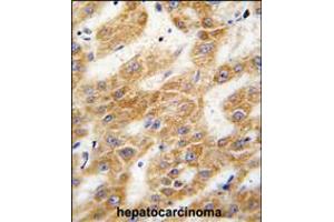 Formalin-fixed and paraffin-embedded human hepatocarcinoma tissue reacted with ALDH4A1 antibody , which was peroxidase-conjugated to the secondary antibody, followed by DAB staining. (ALDH4A1 抗体  (C-Term))