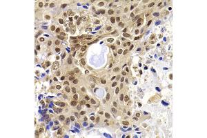 Immunohistochemistry of paraffin-embedded human oophoroma using PHF19 antibody (ABIN5975738) at dilution of 1/100 (40x lens). (PHF19 抗体)