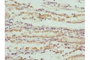 Immunohistochemistry of paraffin-embedded human gastric cancer using ABIN7166101 at dilution of 1:100 (SCO2 抗体  (AA 1-130))