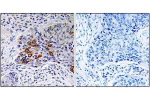 Immunohistochemistry analysis of paraffin-embedded human lung carcinoma tissue, using ADCY9 antibody. (ADCY9 抗体)