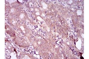 Immunohistochemical analysis of paraffin-embedded cervical cancer tissues using EGFR mutant mouse mAb with DAB staining. (EGFR Mutant (AA 693-893), (Mutant) 抗体)