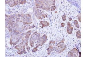 IHC-P Image Immunohistochemical analysis of paraffin-embedded Cal27 xenograft , using Calsequestrin-2, antibody at 1:500 dilution. (CASQ2 抗体)