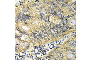 Immunohistochemistry of paraffin-embedded human colon cancer using KLKB1 antibody at dilution of 1:200 (400x lens). (KLKB1 抗体)