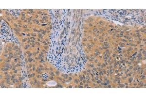 Immunohistochemistry of paraffin-embedded Human cervical cancer using BRS3 Polyclonal Antibody at dilution of 1:50 (BRS3 抗体)