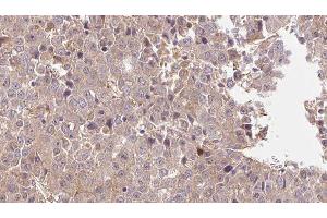 ABIN6275975 at 1/100 staining Human liver cancer tissue by IHC-P. (PTH1R 抗体  (pThr1))