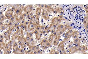 Detection of SAA in Human liver cirrhosis Tissue using Polyclonal Antibody to Serum Amyloid A (SAA) (SAA 抗体  (AA 19-122))