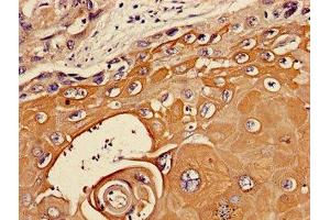 Immunohistochemistry of paraffin-embedded human ovarian cancer using ABIN7174048 at dilution of 1:100 (TIE1 抗体  (AA 217-328))