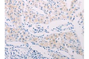 The image on the left is immunohistochemistry of paraffin-embedded Human lung cancer tissue using ABIN7189656(ADAMTS17 Antibody) at dilution 1/60, on the right is treated with synthetic peptide. (ADAMTS17 抗体)