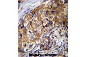 CTAGE5 Antibody (C-term) immunohistochemistry analysis in formalin fixed and paraffin embedded human breast carcinoma followed by peroxidase conjugation of the secondary antibody and DAB staining. (MIA2 抗体  (C-Term))