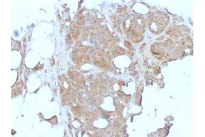 Formalin-fixed, paraffin-embedded human Breast Carcinoma stained with MVP Monoclonal Antibody (1032). (MVP 抗体)