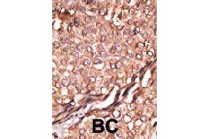 Formalin-fixed and paraffin-embedded human breast cancer tissue reacted with BAIAP2 polyclonal antibody  , which was peroxidase-conjugated to the secondary antibody, followed by AEC staining. (BAIAP2 抗体  (C-Term))