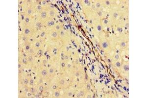 Immunohistochemistry of paraffin-embedded human liver cancer using ABIN7174393 at dilution of 1:100 (OTUB1 抗体  (AA 2-201))