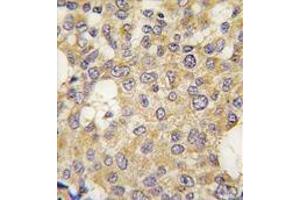 Formalin-fixed and paraffin-embedded human breast carcinoma tissue reacted with Parg antibody (C-term) , which was peroxidase-conjugated to the secondary antibody, followed by DAB staining. (PARG 抗体  (C-Term))