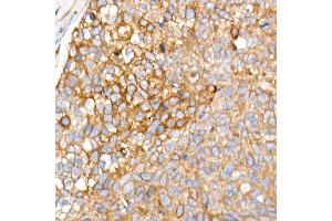 Immunohistochemistry of paraffin-embedded human esophageal cancer using PLOD3 Rabbit mAb (ABIN7269530) at dilution of 1:1600 (40x lens). (PLOD3 抗体)