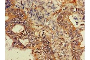 Immunohistochemistry of paraffin-embedded human colon cancer using ABIN7154741 at dilution of 1:100 (GNB4 抗体  (AA 105-185))