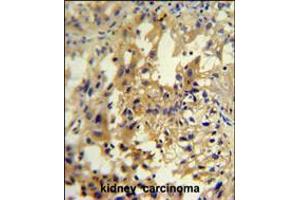 UPP2 antibody immunohistochemistry analysis in formalin fixed and paraffin embedded human kidney carcinoma followed by peroxidase conjugation of the secondary antibody and DAB staining. (UPP2 抗体  (C-Term))