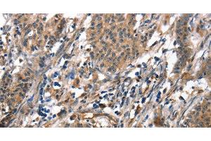 Immunohistochemistry of paraffin-embedded Human gasrtic cancer tissue using ALOX15 Polyclonal Antibody at dilution 1:50 (ALOX15 抗体)