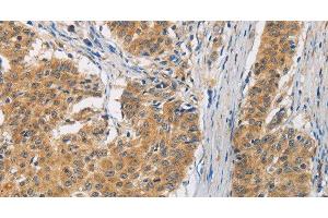 Immunohistochemistry of paraffin-embedded Human gasrtic cancer tissue using FASTK Polyclonal Antibody at dilution 1:30 (FASTK 抗体)