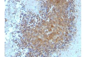Formalin-fixed, paraffin-embedded human Melanoma stained with BAX Mouse Monoclonal Antibody (BAX/962).