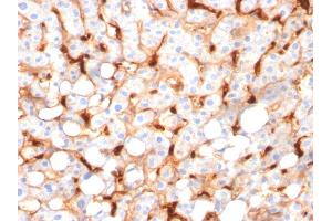 Formalin-fixed, paraffin-embedded human Hepatocellular Carcinoma stained with C1QB Mouse Monoclonal Antibody (C1QB/2966). (C1QB 抗体  (AA 41-188))