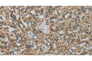 Immunohistochemistry of paraffin-embedded Human esophagus cancer using E2F6 Polyclonal Antibody at dilution of 1:60 (E2F6 抗体)