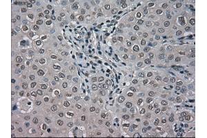 Immunohistochemical staining of paraffin-embedded Adenocarcinoma of colon tissue using anti-BUB1Bmouse monoclonal antibody. (BUB1B 抗体)