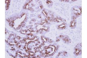 IHC-P Image Immunohistochemical analysis of paraffin-embedded human breast cancer, using Nodal, antibody at 1:250 dilution. (Nodal 抗体  (Center))