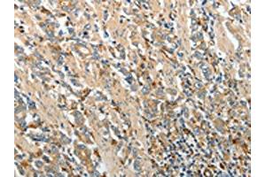 The image on the left is immunohistochemistry of paraffin-embedded Human gastric cancer tissue using ABIN7130695(PRCP Antibody) at dilution 1/20, on the right is treated with fusion protein. (PRCP 抗体)