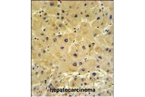 IFT20 Antibody (Center)  IHC analysis in formalin fixed and paraffin embedded hepatocarcinoma followed by peroxidase conjugation of the secondary antibody and DAB staining. (IFT20 抗体  (Center))