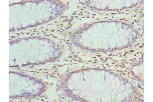 Immunohistochemistry of paraffin-embedded human colon cancer using ABIN7176343 at dilution of 1:100 (ZNF546 抗体  (AA 101-400))